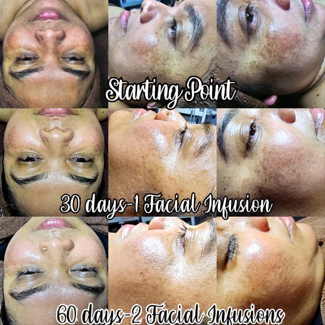 Facial Infusion 3 series 